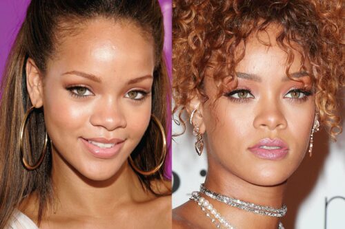 Glutathione Before and After Photos: Rihanna